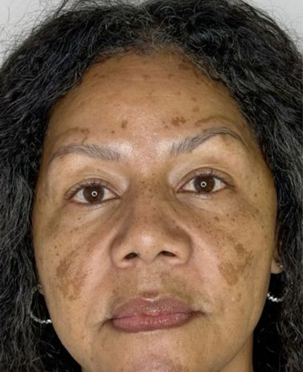 Before Pigmentation