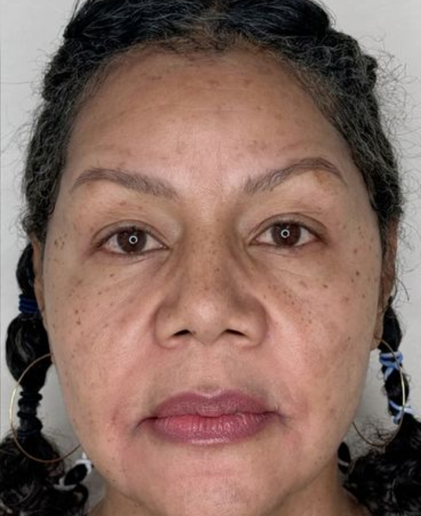 After Pigmentation