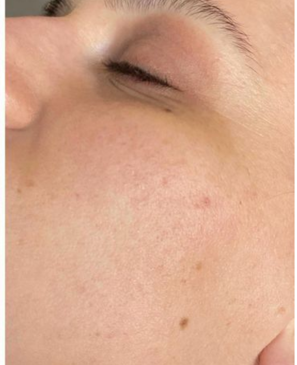 After Acne