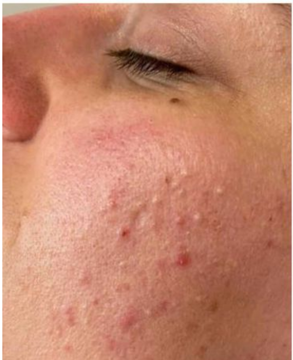Before Acne