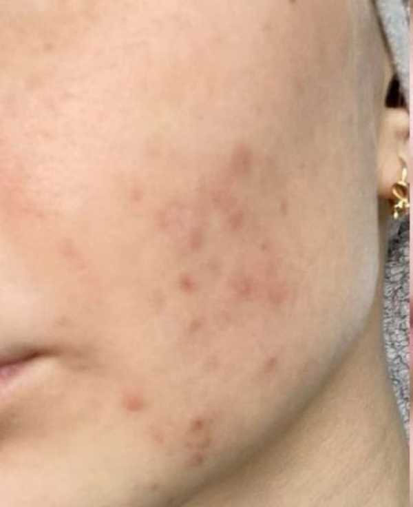 Before Dull & Tired Skin