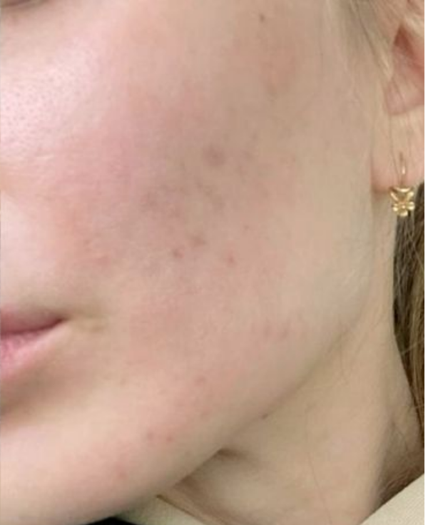 After Dull & Tired Skin