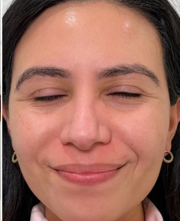 After Dull Skin